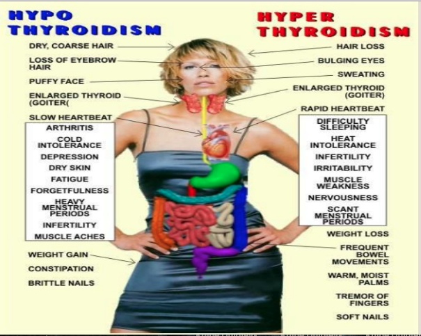 Is Hashimoto Disease Hyperthyroidism